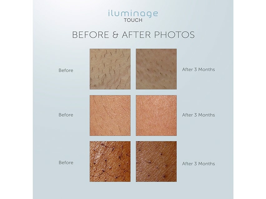 iluminage Touch 4Ever Home Permanent Hair Removal IPL & Radio Frequency System