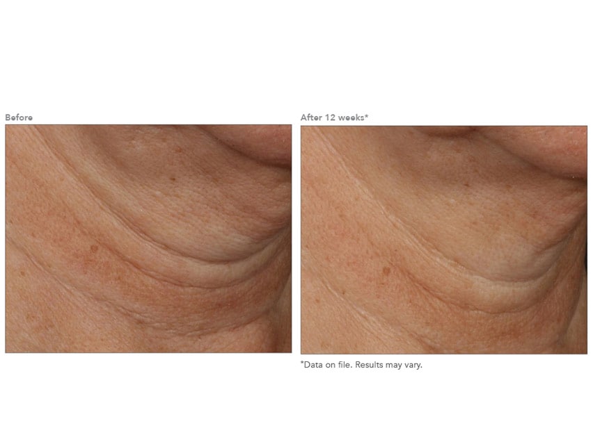 Revision Skincare Nectifirm ADVANCED before and after results 2