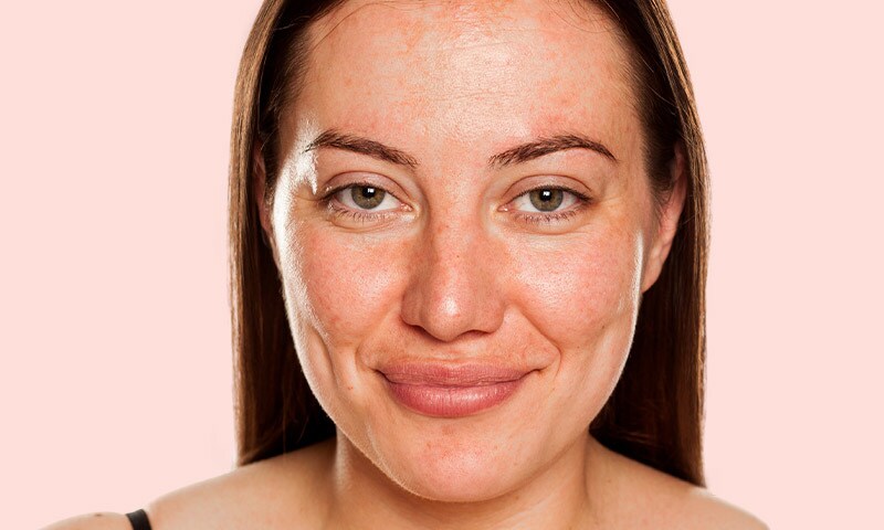 Woman with rosacea smiling
