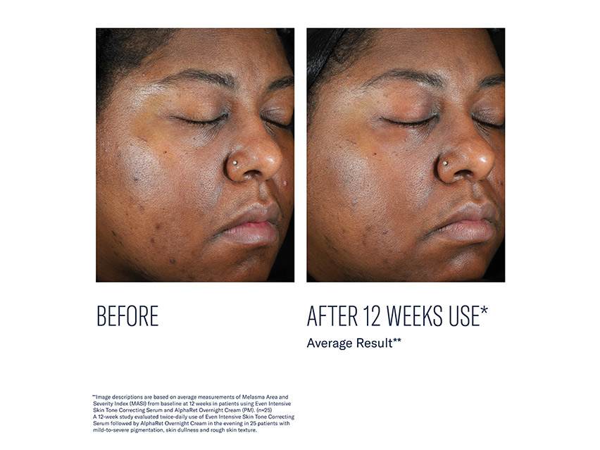 skinbetter science Even Intensive Skin Tone Correcting Serum