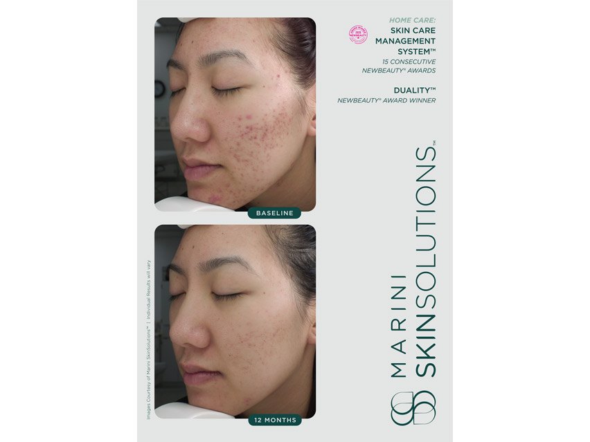 Marini SkinSolutions Duality Acne Treatment Cream &amp; Anti-Aging Complex