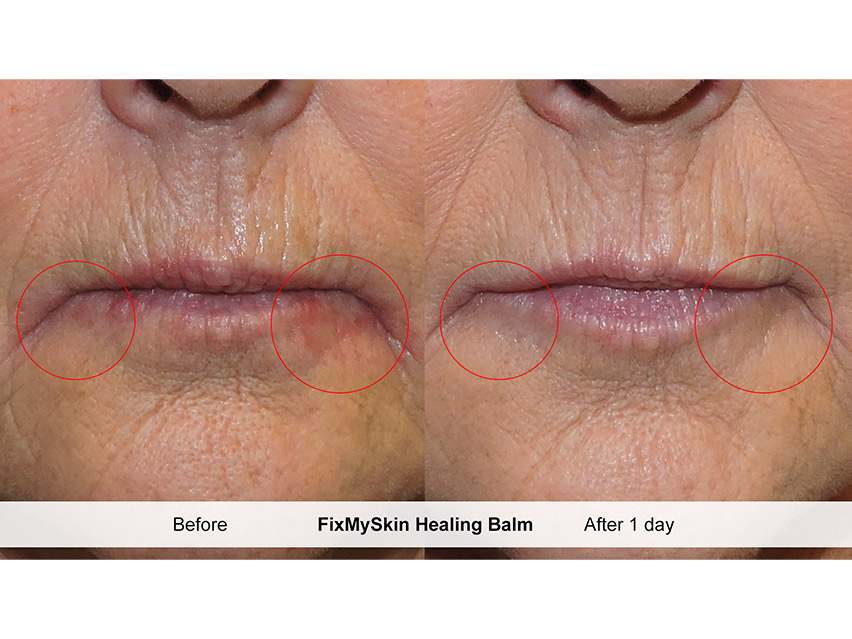 FixMySkin 1% Hydrocortisone Healing Lip Balm – Vanilla &amp; Unflavored - Pack of 6