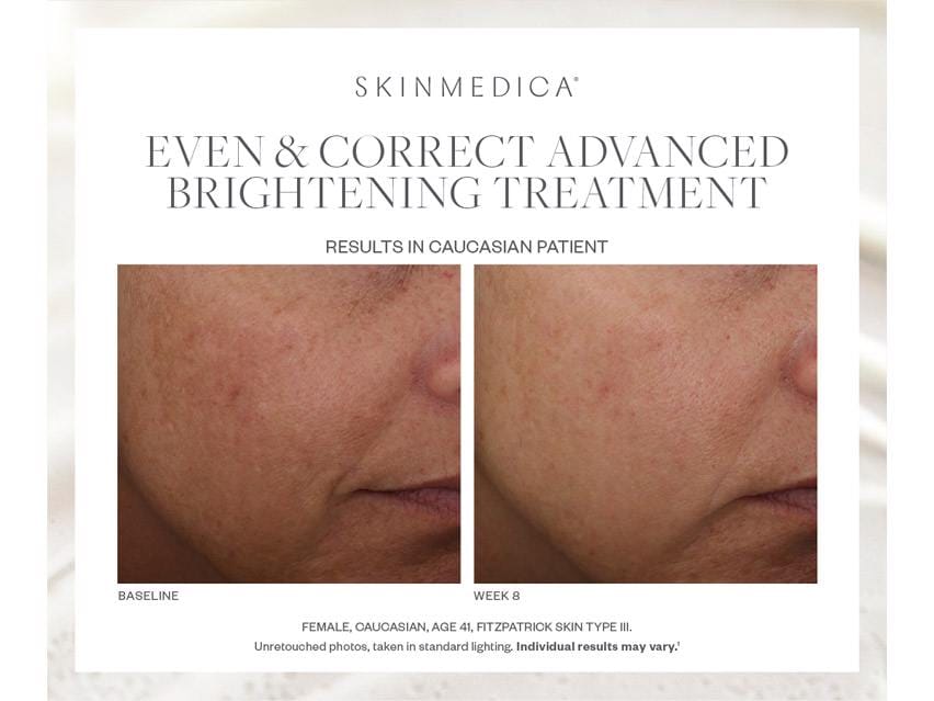 SkinMedica Even & Correct Advanced Brightening Treatment Serum