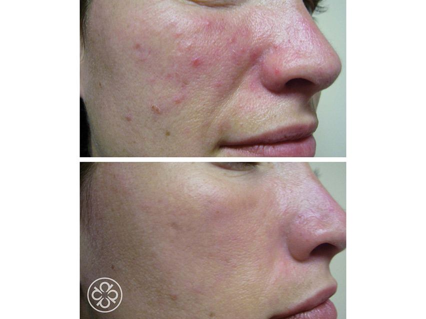 Pevonia SpaTeen Blemished Skin Moisturizer