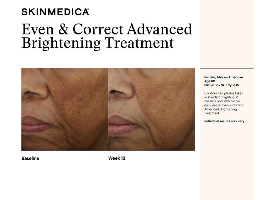 SkinMedica Even &amp; Correct Dark Spot Cream