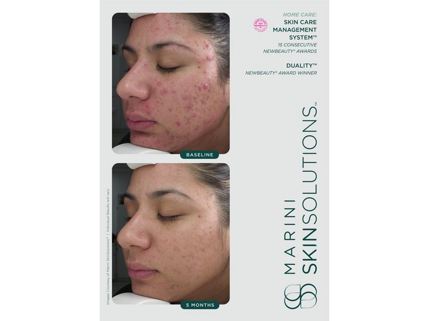 Marini SkinSolutions Duality Acne Treatment Cream &amp; Anti-Aging Complex
