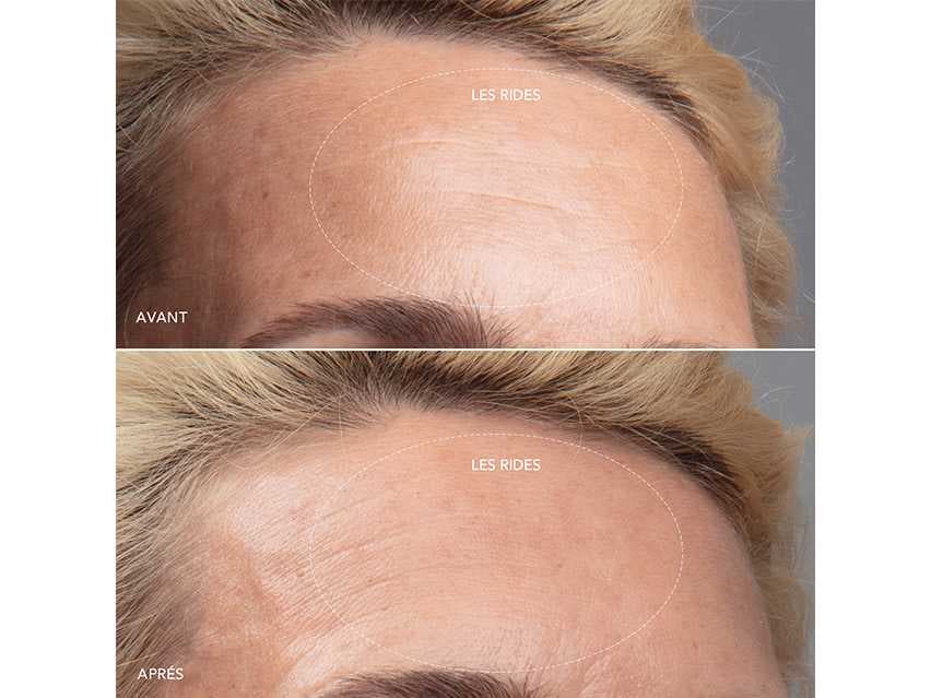 FOREO KIWI™ Renewal Treatment derma LovelySkin | Skin