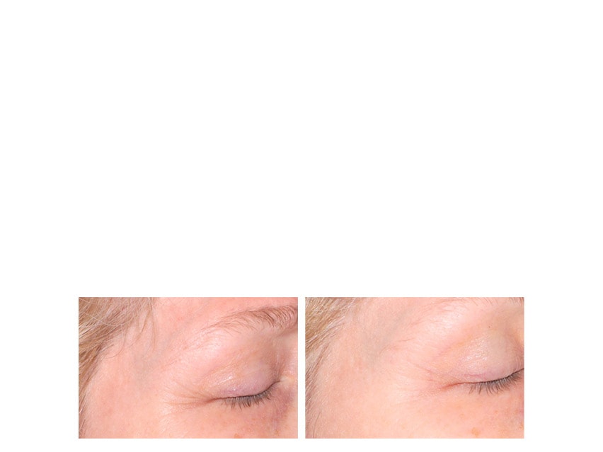 Quasar MD Plus Wrinkle Reducing Therapy