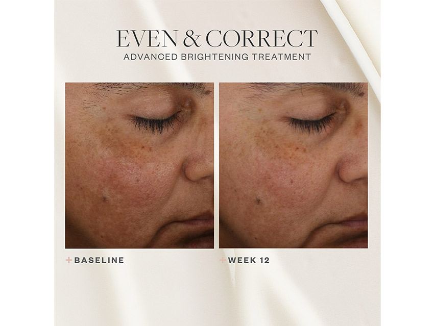 SkinMedica Even &amp; Correct Advanced Brightening Treatment Serum