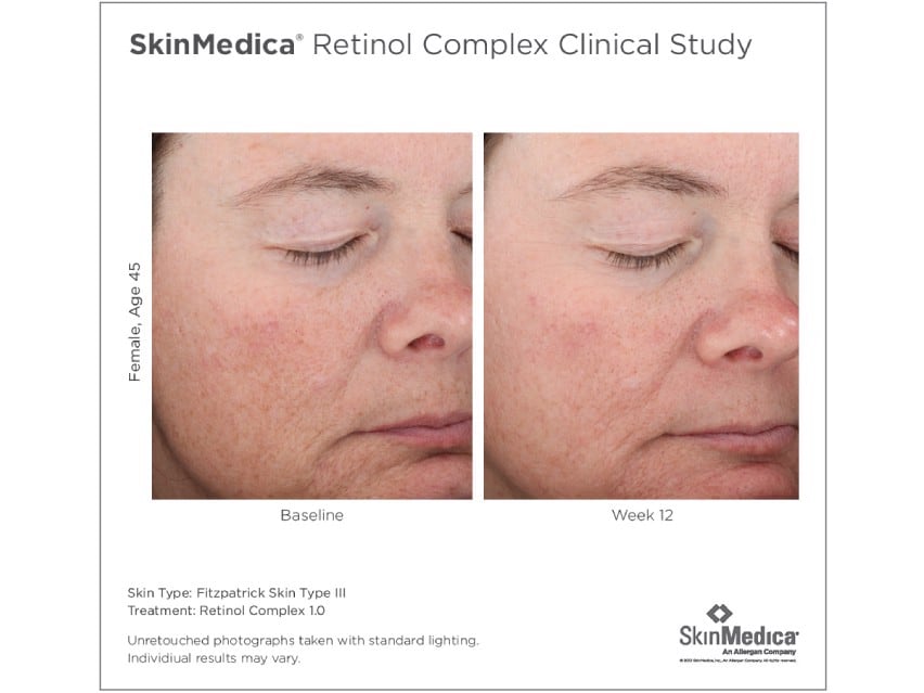 SkinMedica Retinol Complex 1.0 | LovelySkin