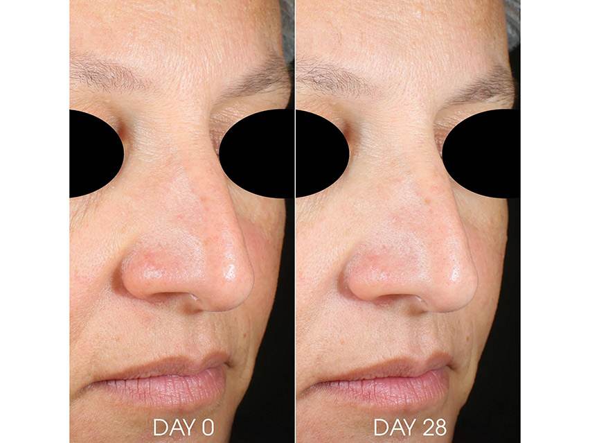 TEOXANE RHA Hydra Mask