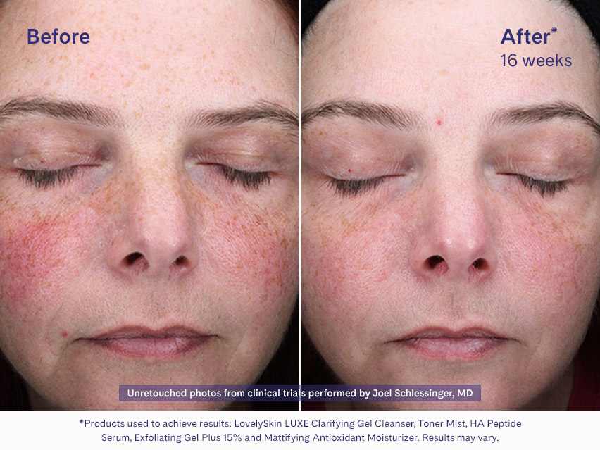 LovelySkin LUXE Exfoliating Gel Plus 15%