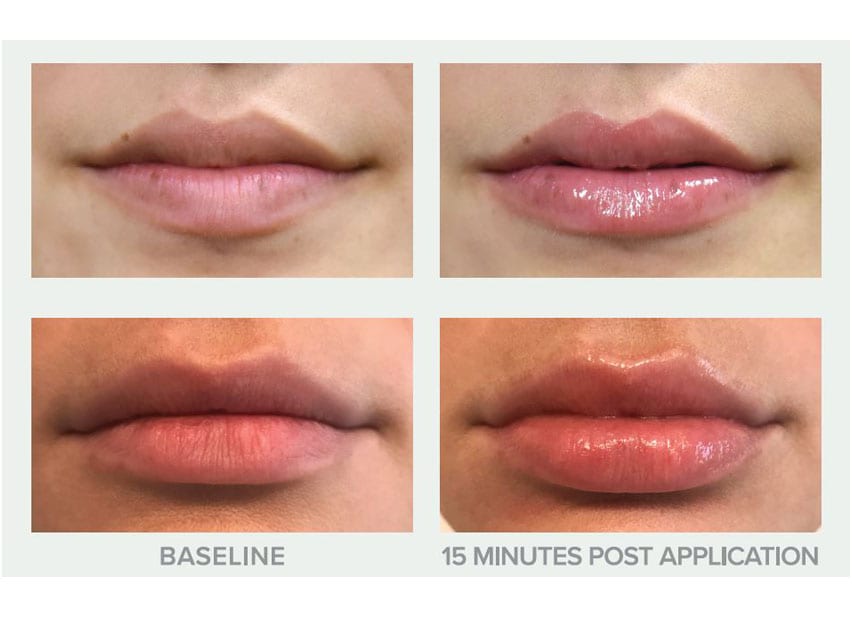 Before and After Photos of Replenix Pure Hydration Plumping Lip Treatment SPF 30