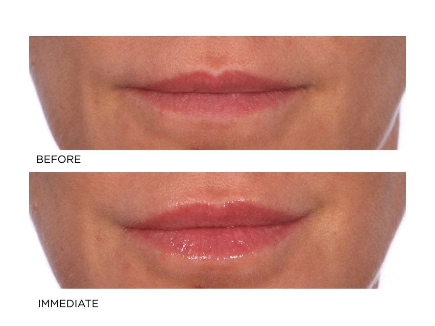 NassifMD&#174; Hydro-Screen for Lips