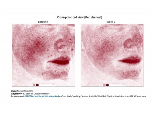 sente dermal repair for hyperpigmentation