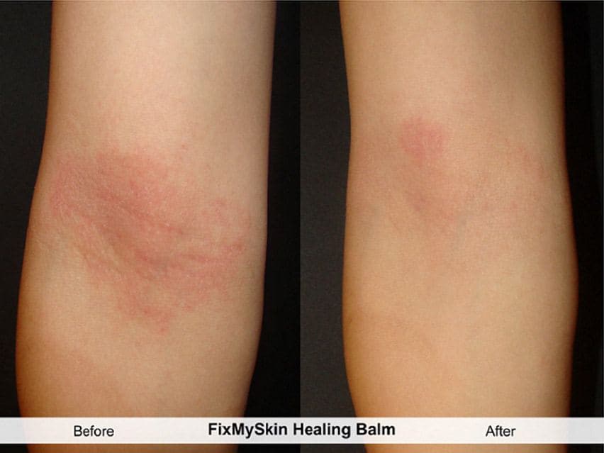 FixMySkin 1% Hydrocortisone Healing Body Balm - Fragrance-Free - Pack of 12