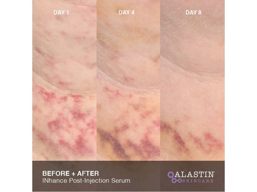 ALASTIN Skincare INhance Post-Injection Serum with TriHex Technology