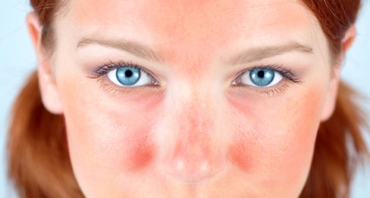 Learn About Rosacea Products and Symptoms During Rosacea Awareness Month
