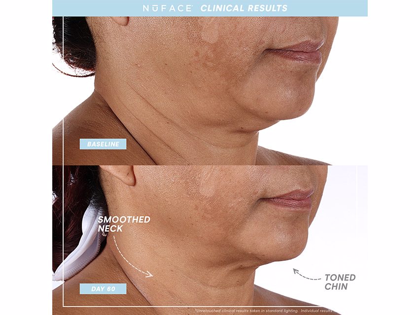 NuFACE Before and After Photos showing a woman with a smoother neck and more toned chin after using the NuFace neck tightening device for 60 days.  