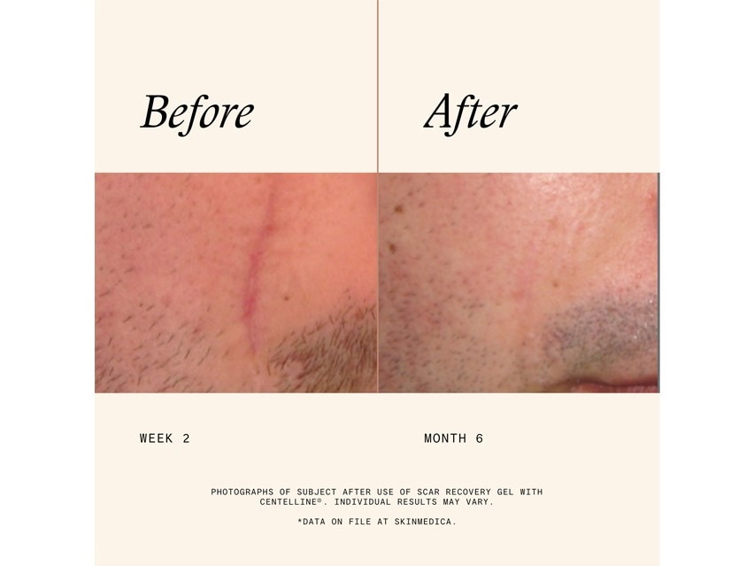 SkinMedica Scar Recovery Gel with Centelline™