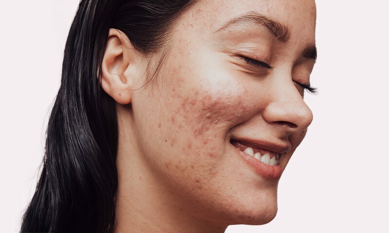 Woman smiling with acne on her cheeks