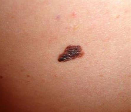 Skin cancer: Learn about the types of skin cancer from Joel Schlessinger MD