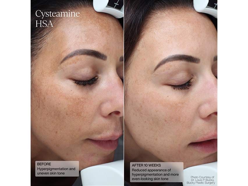 Senté Cysteamine HSA & Dermal Repair Cream Duo - $198 Value!