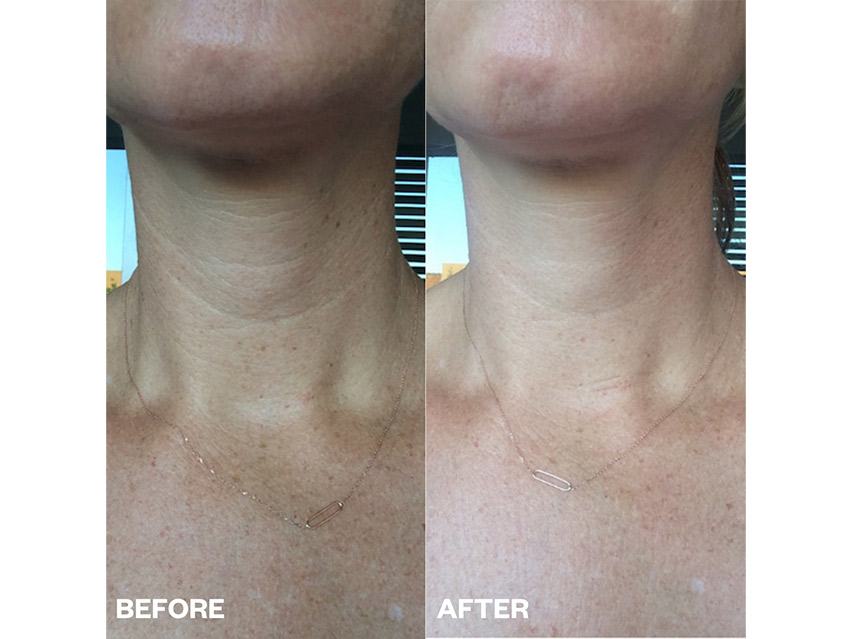 Wrinkles Schminkles Neck Wrinkle Smoothing Patch