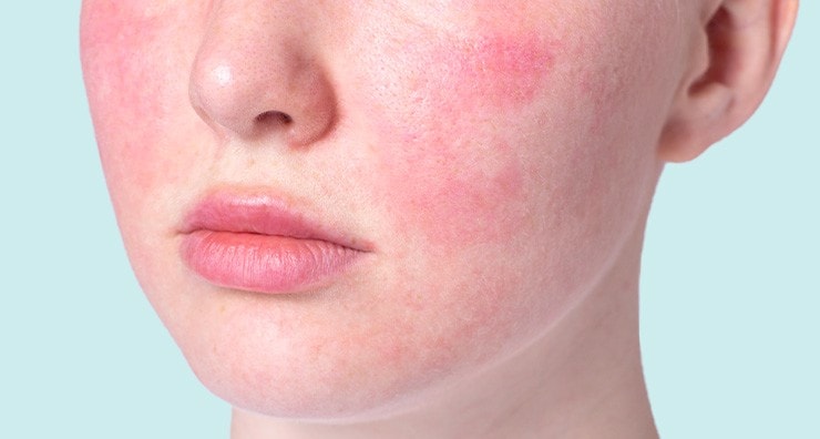 Your best skin care routine for rosacea