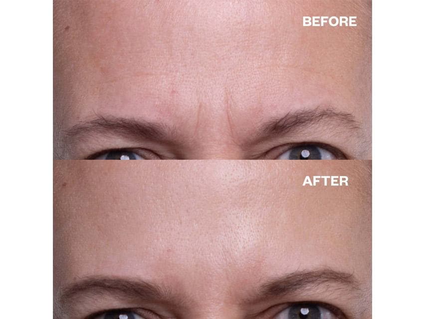 Wrinkles Schminkles Forehead Wrinkle Smoothing Patches