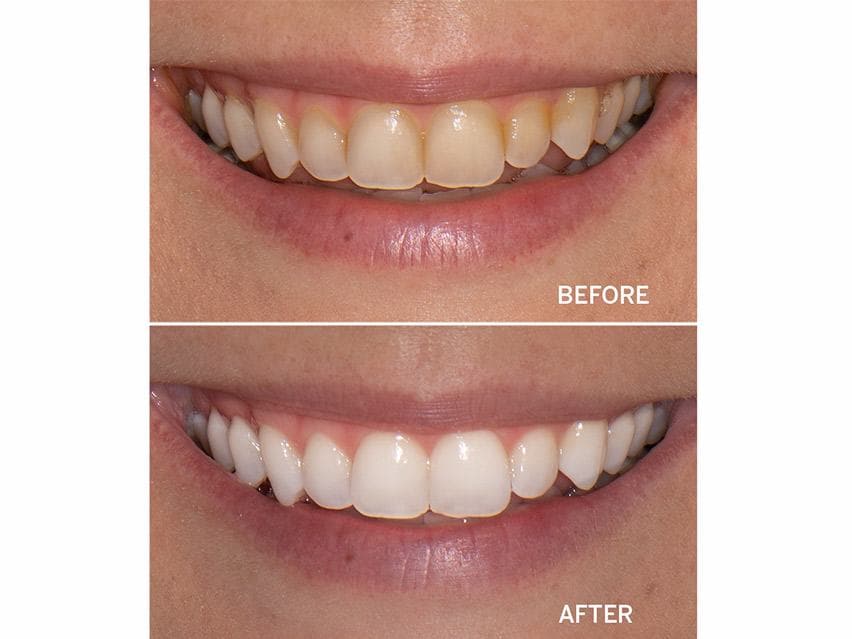 Supersmile Professional Whitening System - Travel Size