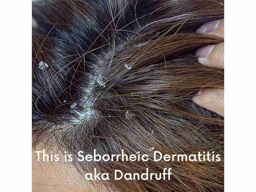 DERMAdoctor Calm Cool + Corrected Tranquility Cleanser for Seborrheic Dermatitis &amp; Dandruff