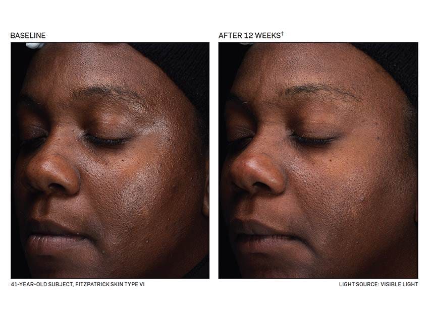Before and After images of using Revision Skincare D·E·J Daily Boosting Serum for 12 weeks on dark skin