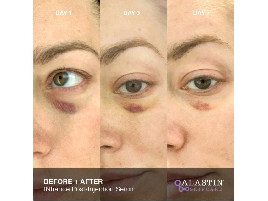 ALASTIN Skincare INhance Post-Injection Serum with TriHex Technology