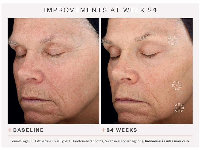 SkinMedica TNS Advanced+ Serum Before and After Photos