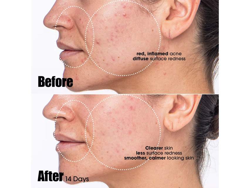 Sunday Riley Peacekeeper Acne Treatment Serum