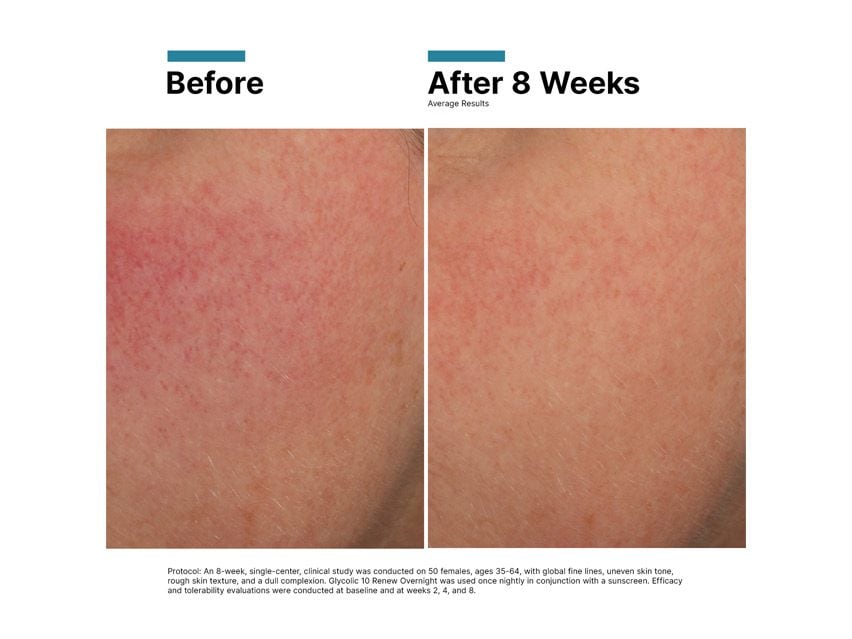 SkinCeuticals Glycolic 10 Renew Overnight Exfoliating Treatment