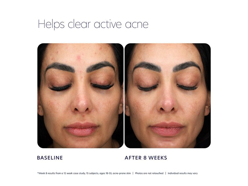 PCA SKIN Acne Control Prebiotic Gel Cleanser