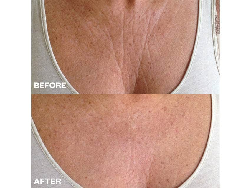 Wrinkles Schminkles Chest Wrinkle Patch