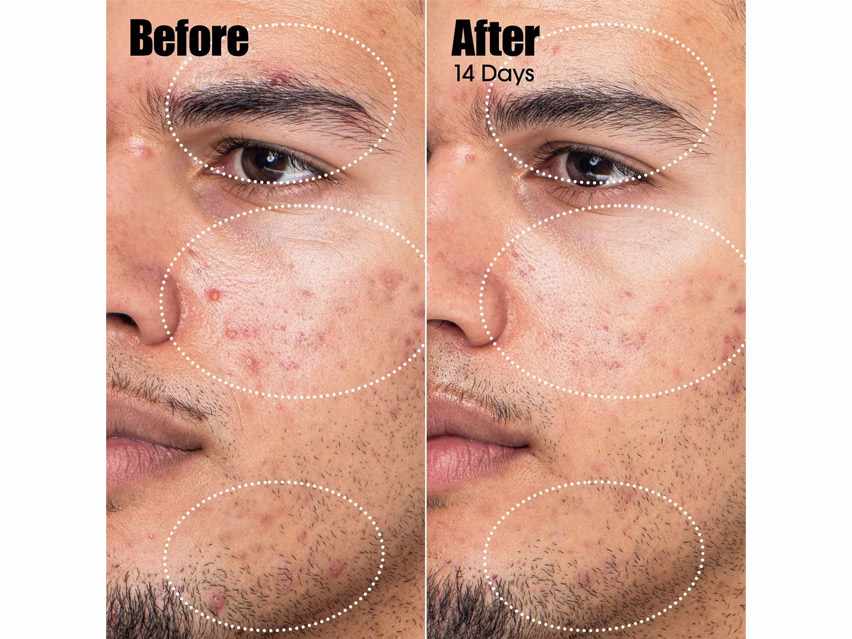 Sunday Riley Peacekeeper Acne Treatment Serum