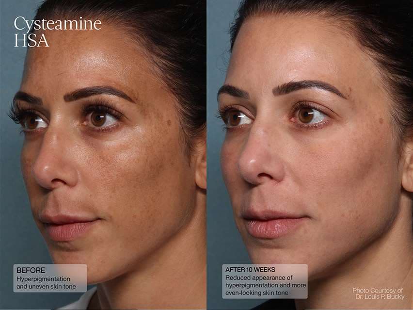 Senté Cysteamine HSA & Dermal Repair Cream Duo - $198 Value!