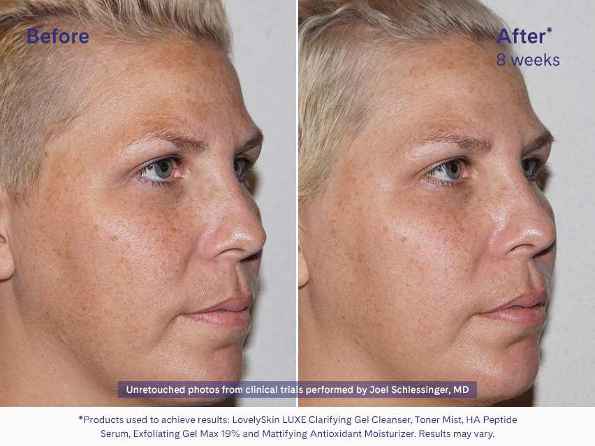 LovelySkin LUXE Exfoliating Gel Max 19%