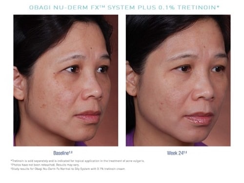 obagi nu derm normal to oily