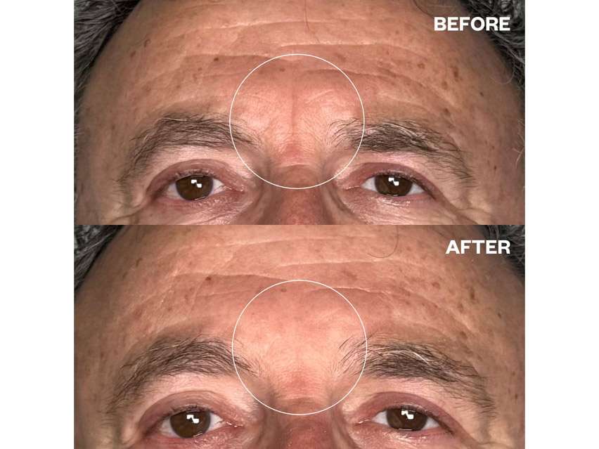 Wrinkles Schminkles Men's Pro Forehead Wrinkle Patches