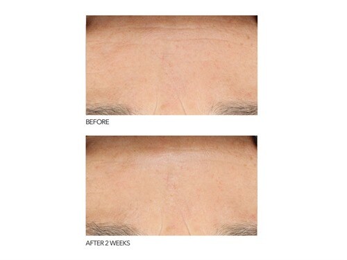 dr gross clinical grade peel