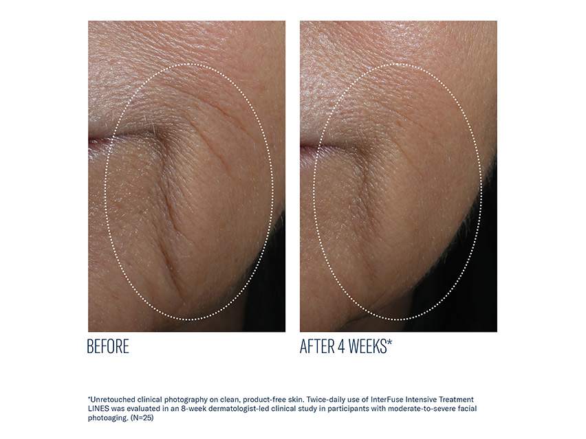 skinbetter science InterFuse Intensive Treatment LINES