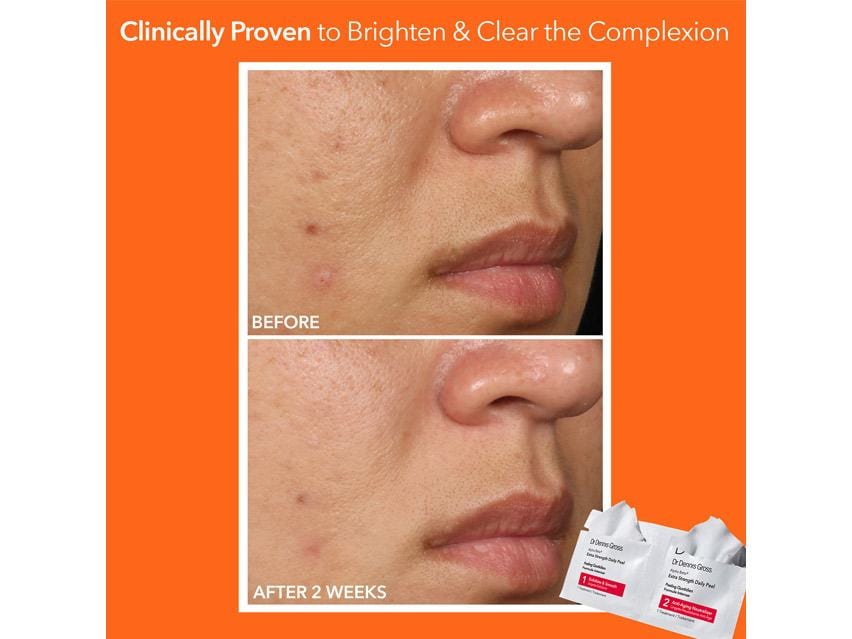 Dr. Dennis Gross Skincare Alpha Beta Extra Strength Daily Peel