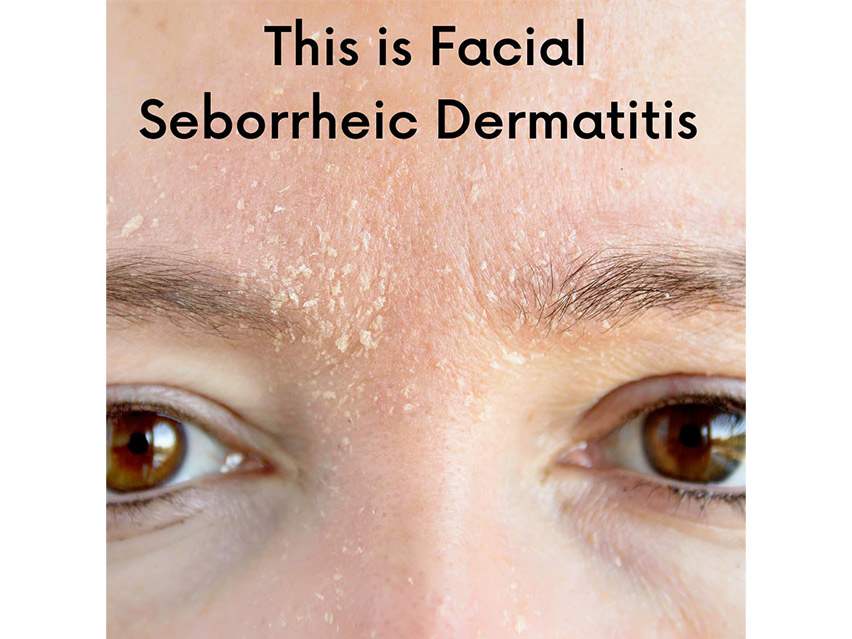 DERMAdoctor Calm Cool + Corrected Tranquility Cleanser for Seborrheic Dermatitis &amp; Dandruff