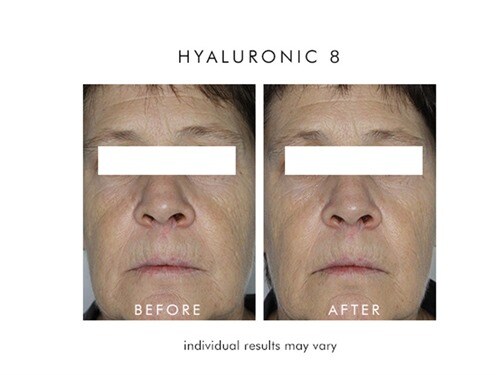 alpha h hyaluronic 8