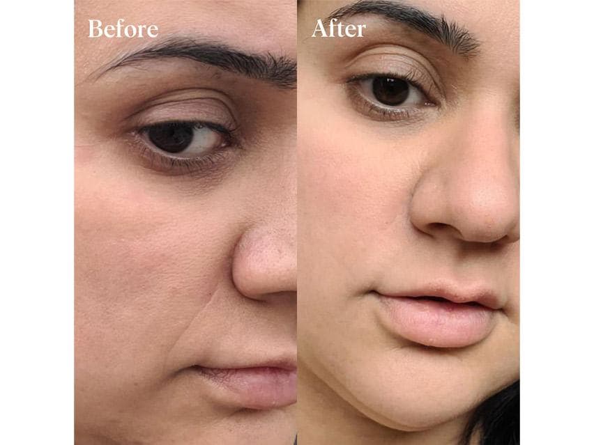 Wrinkles Schminkles Self-Dissolving Microneedle Patches